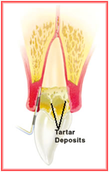 Cirugia periodontal 00725